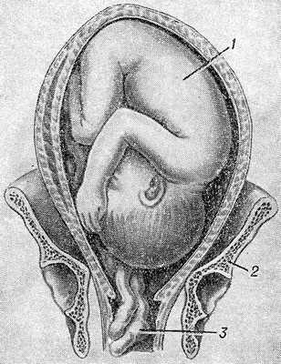 Рис. 1. Схематическое изображение выпадения пуповины в родах (фронтальный разрез матки и костей таза): 1 — плод; 2 — таз; 3 — пуповина.