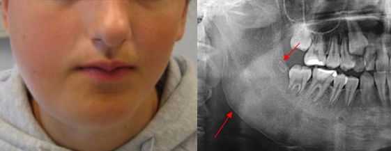 Остеомилеит челюсти [19]