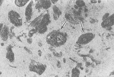 Рис. 1. Микрофотография макрофагов (указаны стрелками) в очаге асептического воспаления (препарат Г. Г. Кругликова); окраска толуидиновым синим; X 630.