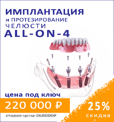 Акция все-на-четырех полный протез на имплантах