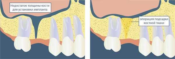 наращивание костной ткани