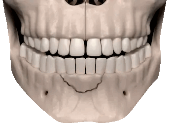 перелом альвеолярного отростка