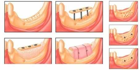 Пластика альвеолярного отростка