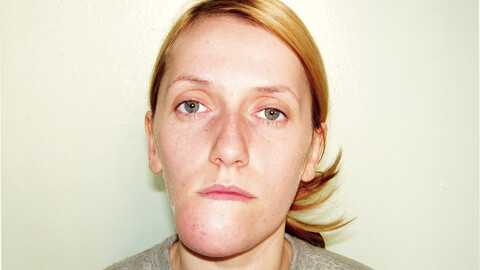 Амелобластома