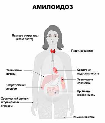 Амилоидоз симптомы.jpg