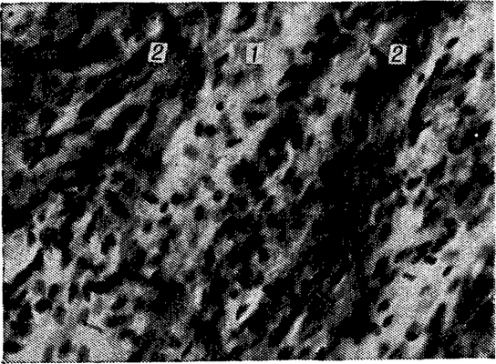 Рис. 2. Микропрепарат травматической невромы: видно разрастание плотной соединительной ткани (1) между нервными волокнами (2); окраска гематоксилин-пик-рофуксином, х 300