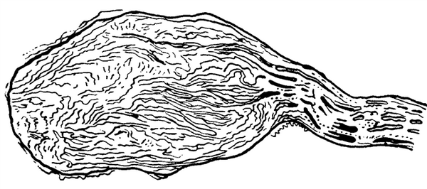 Рис. 1. Схематическое изображение регенерационной невромы центрального конца нерва, образовавшейся после полного анатомического перерыва нерва.