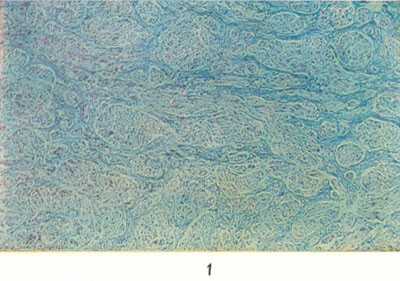 Микропрепарат посттравматической невромы: разрастания нервных волокон и рубцовой ткани; тройная окраска по Массону; X 60.