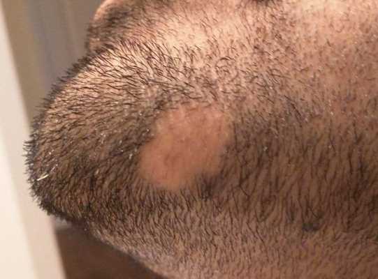 Alopecia areata barbae