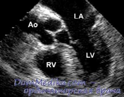 эхокардиография левого желудочка