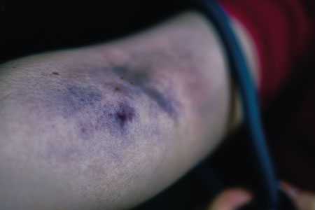 Диагностика наркотической зависимости - Клиника ЛОРДМЕД