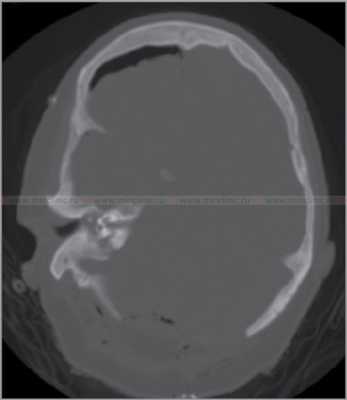 Аксиальная компьютерная томография (КТ) головы. Компьютерная томография (КТ) височной кости выявляет повреждение среднего уха, сосцевидного отростка и подлабиринтного пространства.