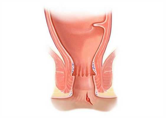 Анальная трещина