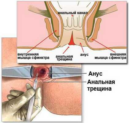 Трещина анального канала