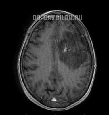 Анапластическая астроцитома