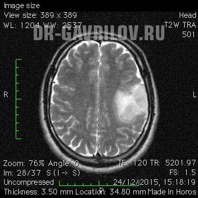 Фибриллярная астроцитома