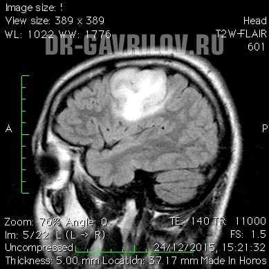 Фибриллярная астроцитома