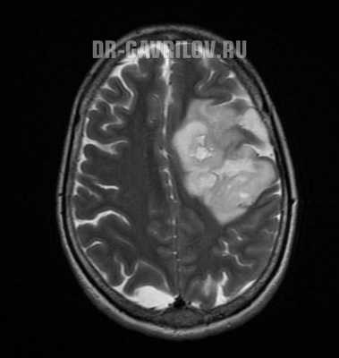 Анапластическая астроцитома