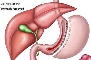 Резекция желудка по бильрот 1