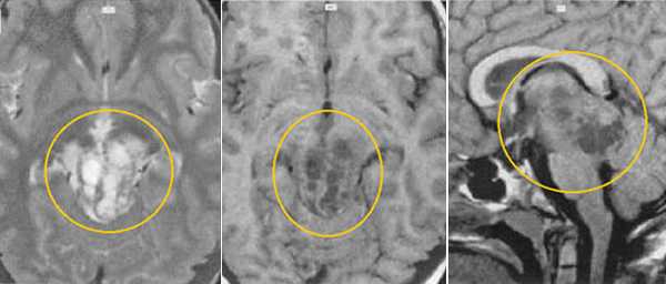  МРТ в диагностике патологий шишковидной железы 