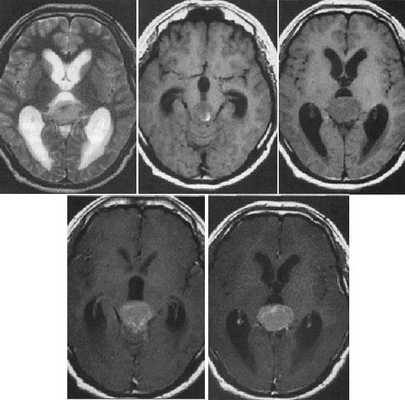  МРТ в диагностике патологий шишковидной железы 