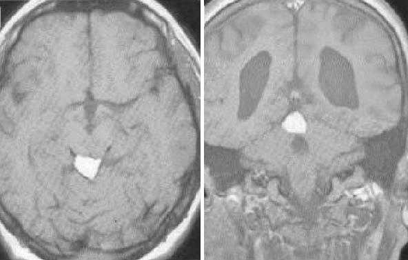  МРТ в диагностике патологий шишковидной железы 