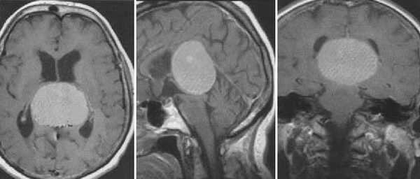  МРТ в диагностике патологий шишковидной железы 