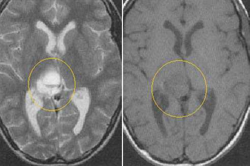  МРТ в диагностике патологий шишковидной железы 