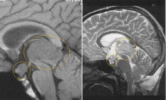  МРТ в диагностике патологий шишковидной железы 