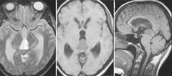  МРТ в диагностике патологий шишковидной железы 