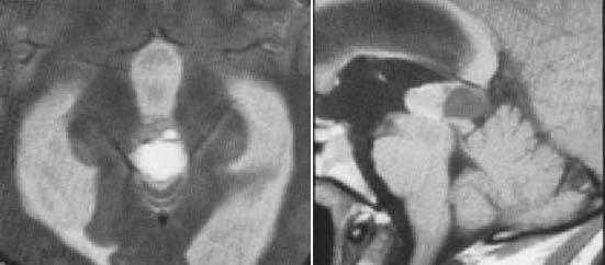 МРТ в диагностике патологий шишковидной железы 