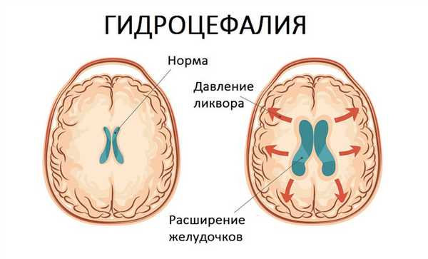 Принцип формирования гидроцефалии