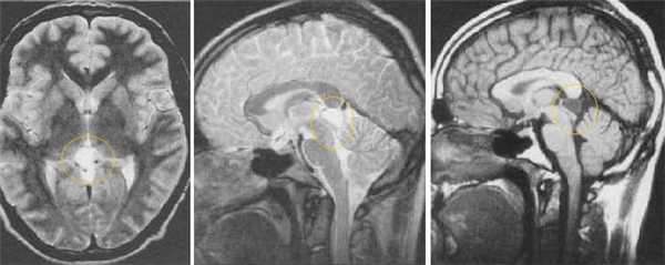  МРТ в диагностике патологий шишковидной железы 