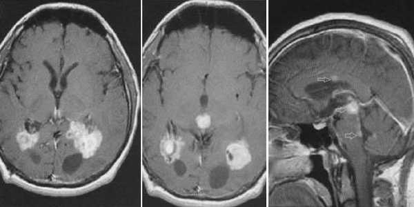  МРТ в диагностике патологий шишковидной железы 