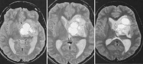  МРТ в диагностике патологий шишковидной железы 