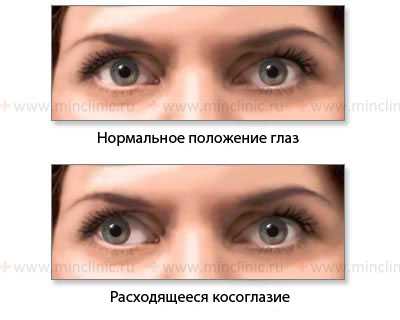 Показано нормальное положение глазных яблок и расходящееся косоглазие при слабости медиальной (внутренней) прямой мышцы глаза справа (III пара черепно-мозговых нервов).