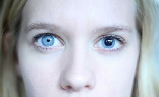 Заболевание глаз - анизокория