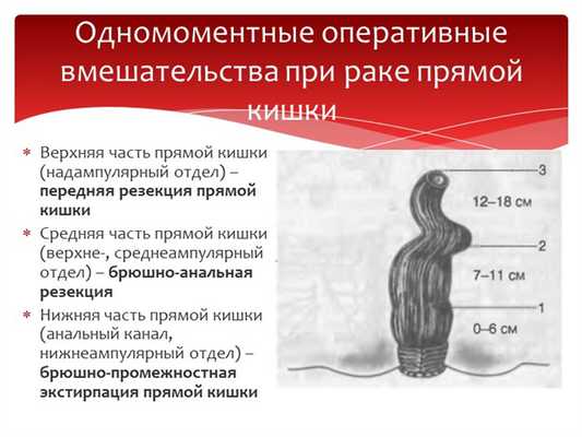 Верхняя часть прямой кишки (надампулярный отдел) - передняя резекция прямой к. 