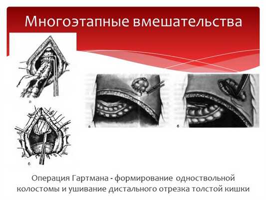Операция Гартмана - формирование одноствольной колостомы и ушивание дистально. 