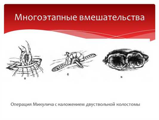Операция Микулича с наложением двуствольной колостомыМногоэтапные вмешательства