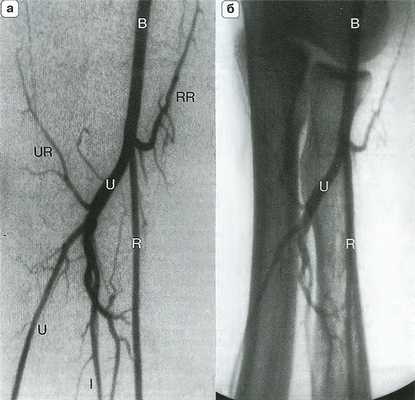 Рис. 14.4. Артериальная анатомия (а) и костные ориентиры (б) локтевого сустава