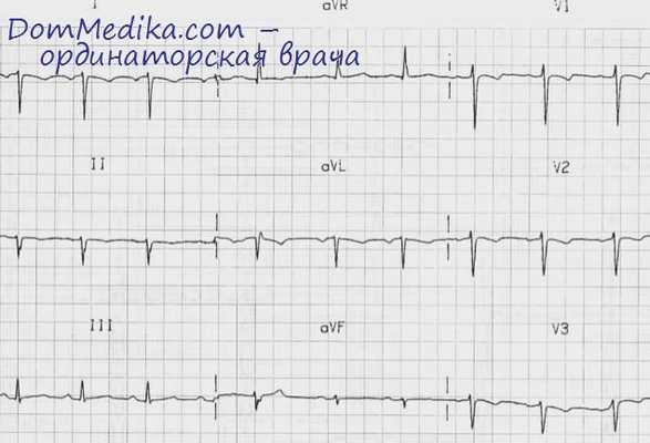 аномалии сердца