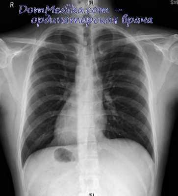 правосформированное сердце