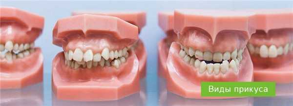 Виды прикуса: какой правильный и как его определить?