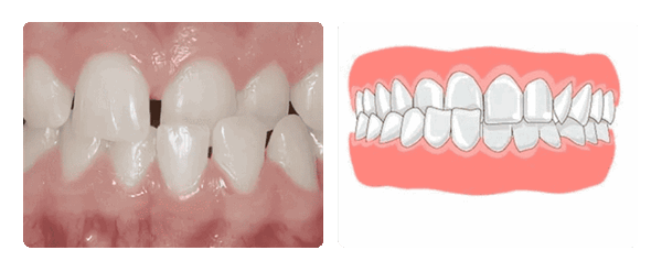 перекрестный прикус