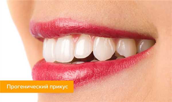 Фото прогенического прикуса