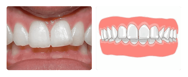 глубокий прикус