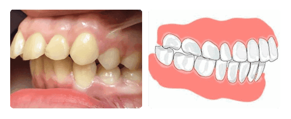 дистальный прикус
