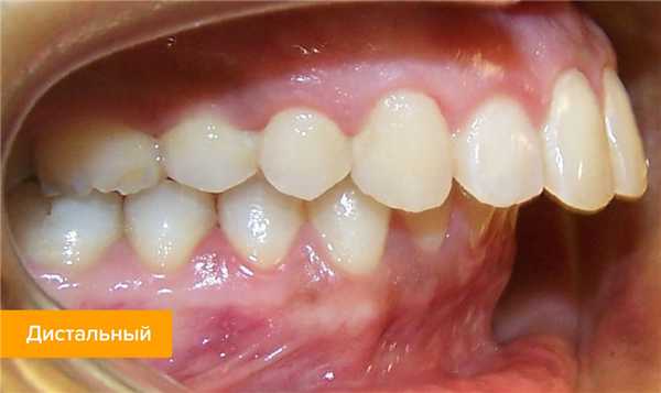 Фото дистального (прогнатического) прикуса