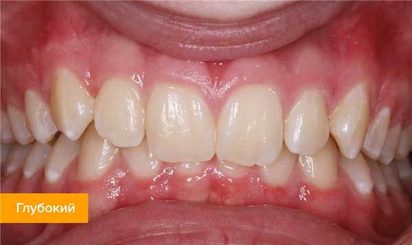 Фото глубокого прикуса